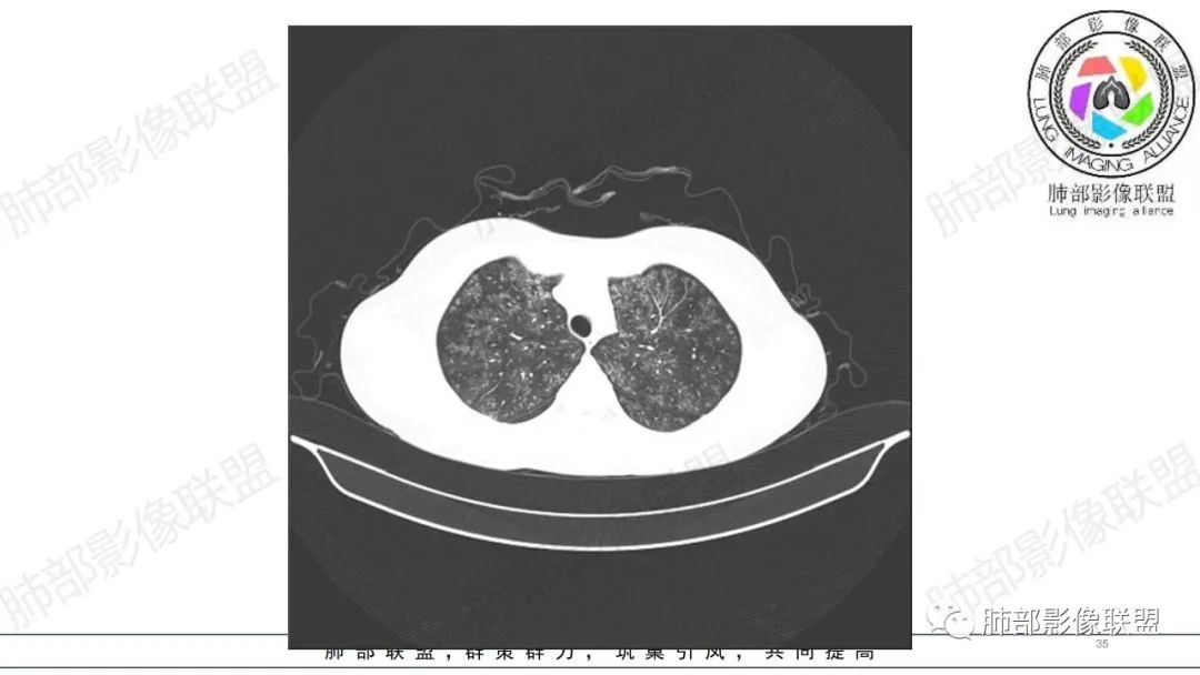 【病例】肺部弥漫大B淋巴瘤病例思考及启示-35