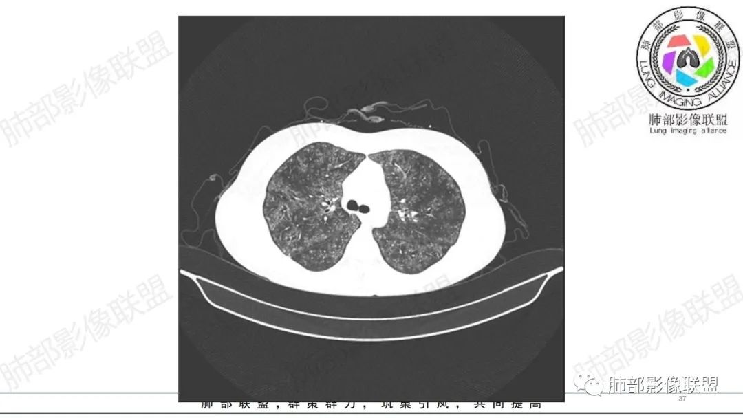 【病例】肺部弥漫大B淋巴瘤病例思考及启示-37