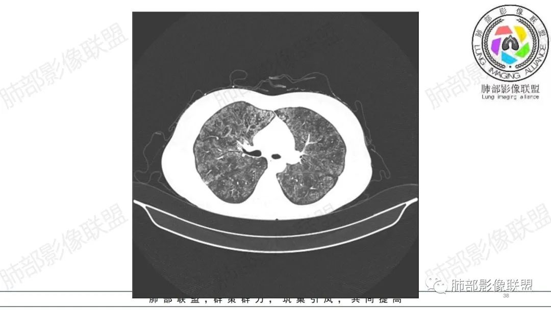 【病例】肺部弥漫大B淋巴瘤病例思考及启示-38