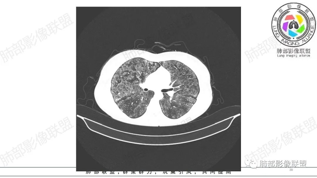 【病例】肺部弥漫大B淋巴瘤病例思考及启示-39
