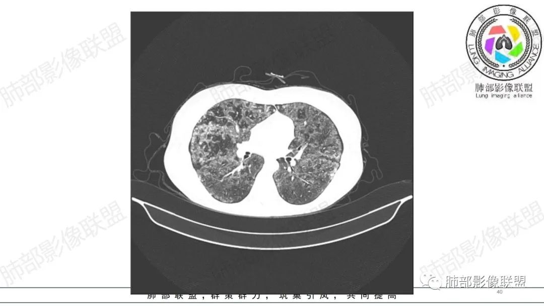 【病例】肺部弥漫大B淋巴瘤病例思考及启示-40