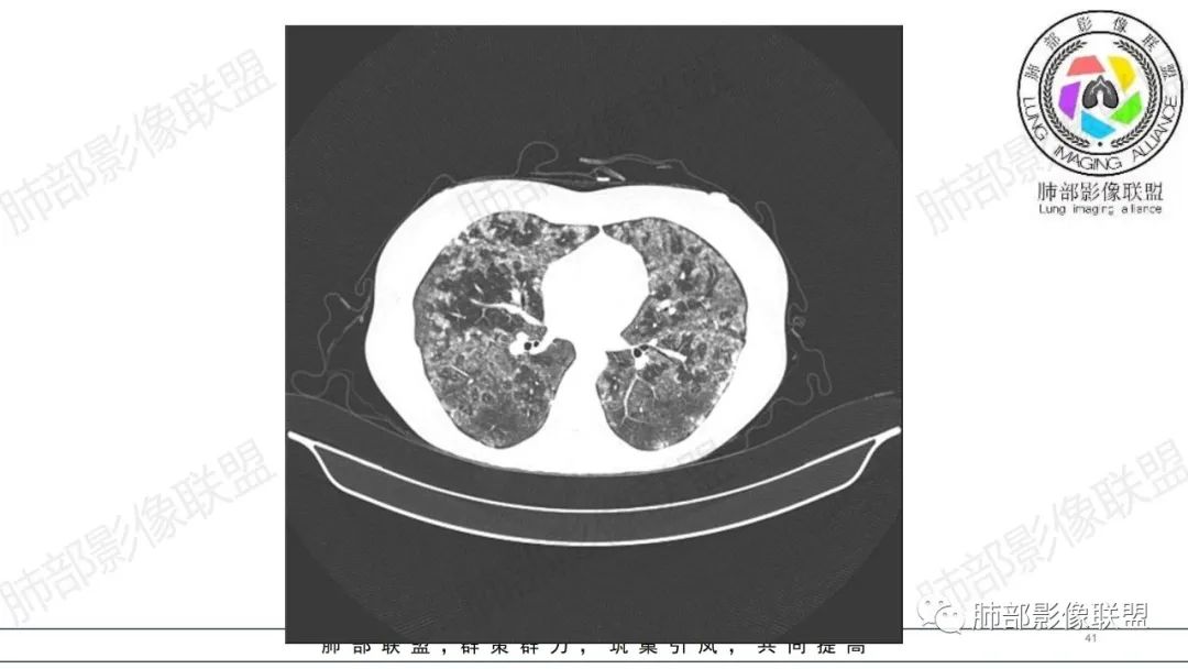 【病例】肺部弥漫大B淋巴瘤病例思考及启示-41