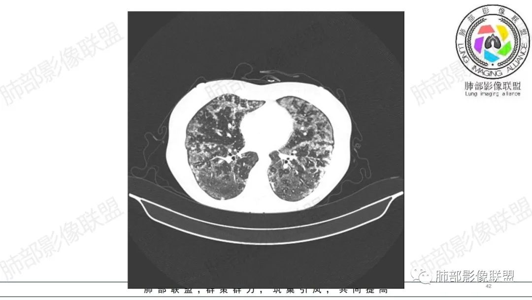 【病例】肺部弥漫大B淋巴瘤病例思考及启示-42