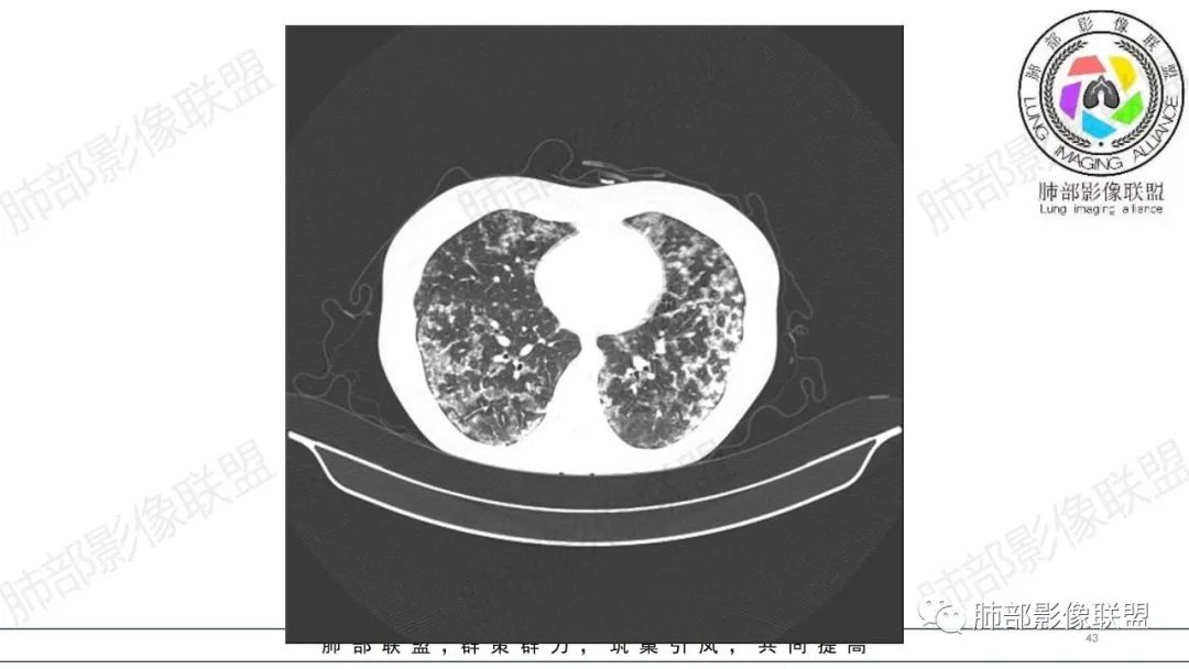 【病例】肺部弥漫大B淋巴瘤病例思考及启示-43