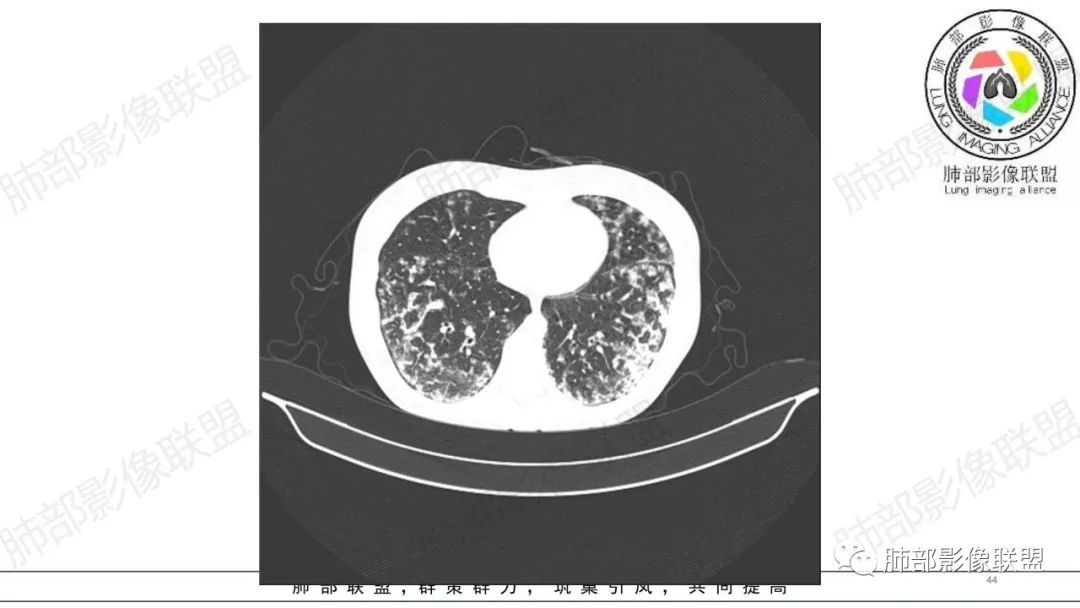 【病例】肺部弥漫大B淋巴瘤病例思考及启示-44