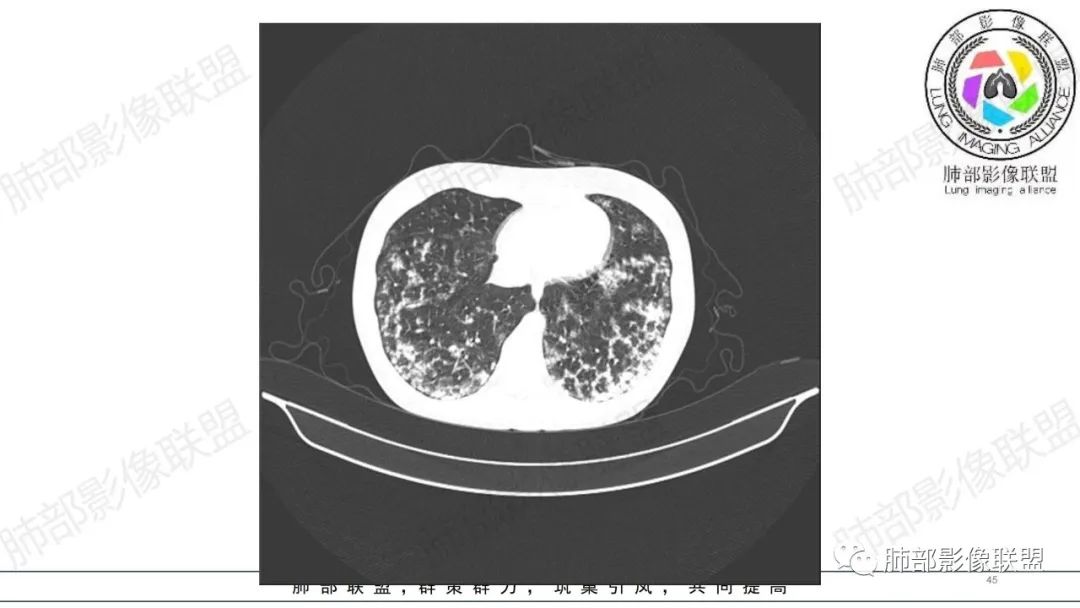 【病例】肺部弥漫大B淋巴瘤病例思考及启示-45