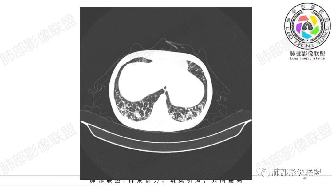 【病例】肺部弥漫大B淋巴瘤病例思考及启示-46