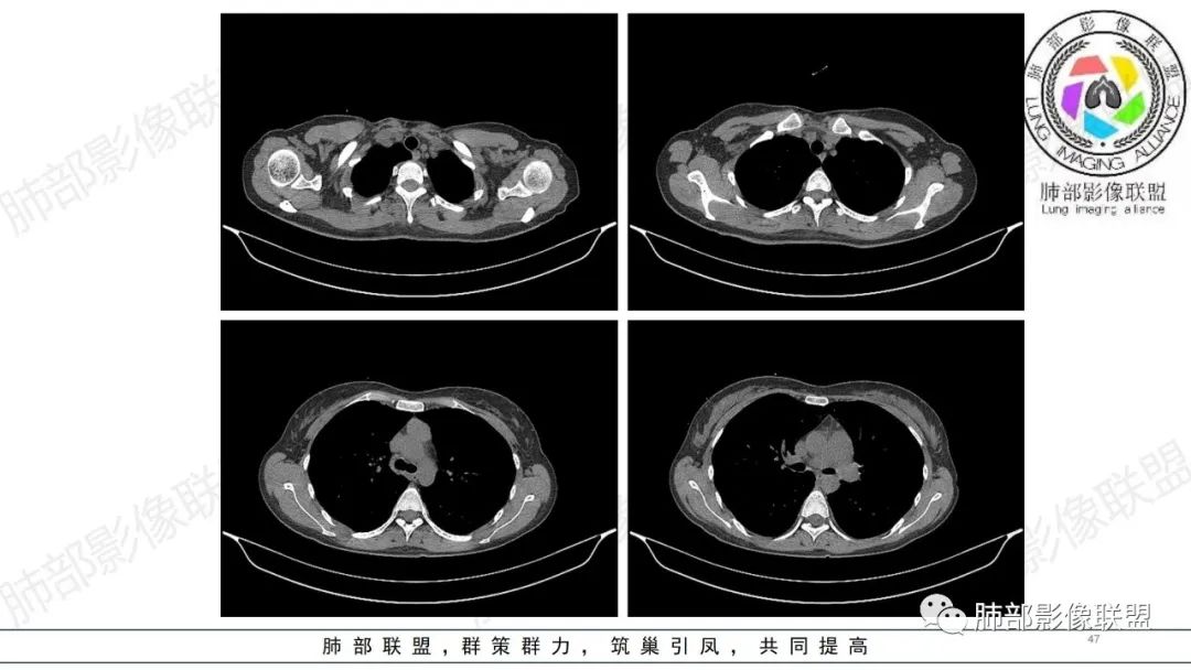 【病例】肺部弥漫大B淋巴瘤病例思考及启示-47