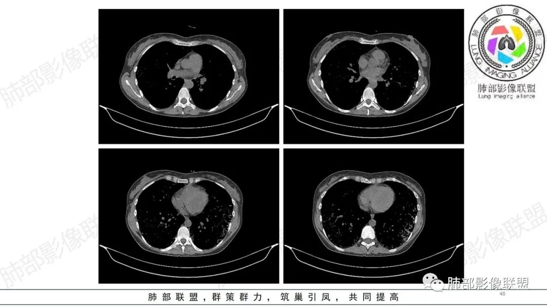 【病例】肺部弥漫大B淋巴瘤病例思考及启示-48