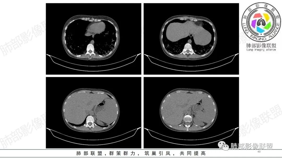 【病例】肺部弥漫大B淋巴瘤病例思考及启示-49