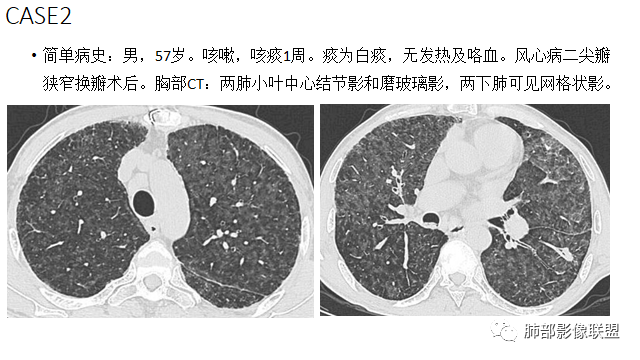 【病例】肺部弥漫大B淋巴瘤病例思考及启示-54