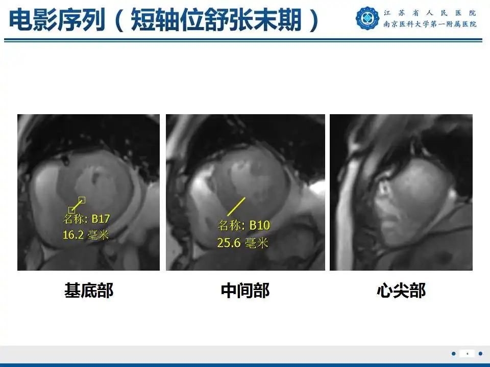 【PPT】心肌淀粉样变-5