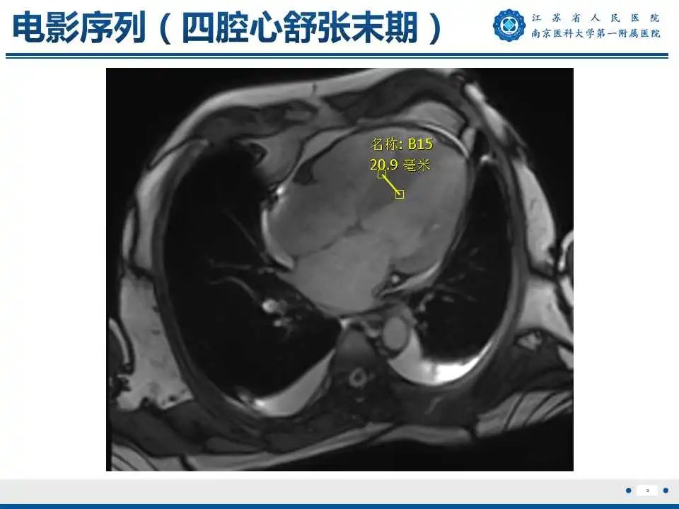 【PPT】心肌淀粉样变-4
