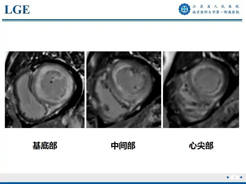 【PPT】心肌淀粉样变-7
