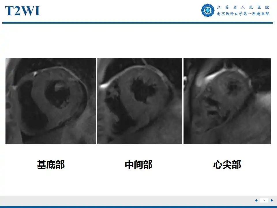 【PPT】心肌淀粉样变-6
