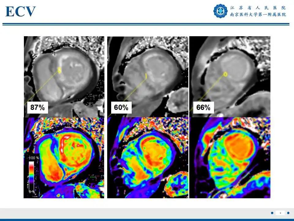 【PPT】心肌淀粉样变-10