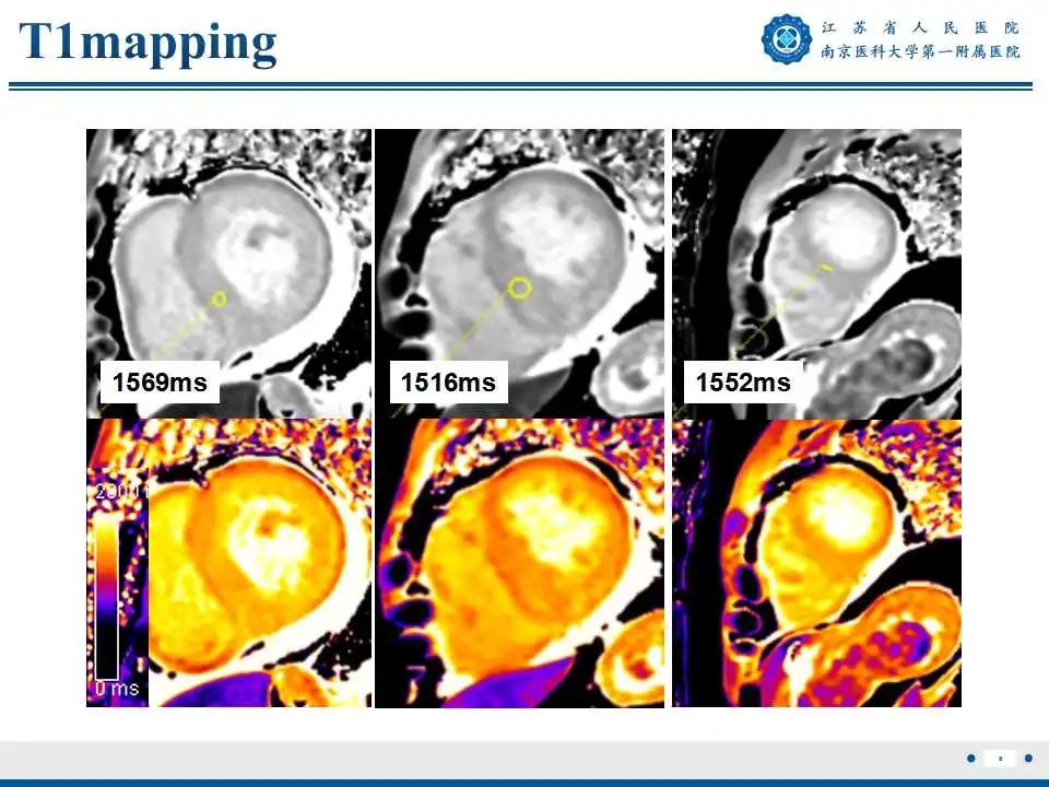 【PPT】心肌淀粉样变-9