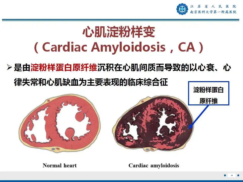 【PPT】心肌淀粉样变-29