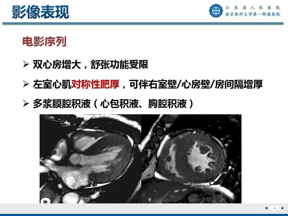 【PPT】心肌淀粉样变-33