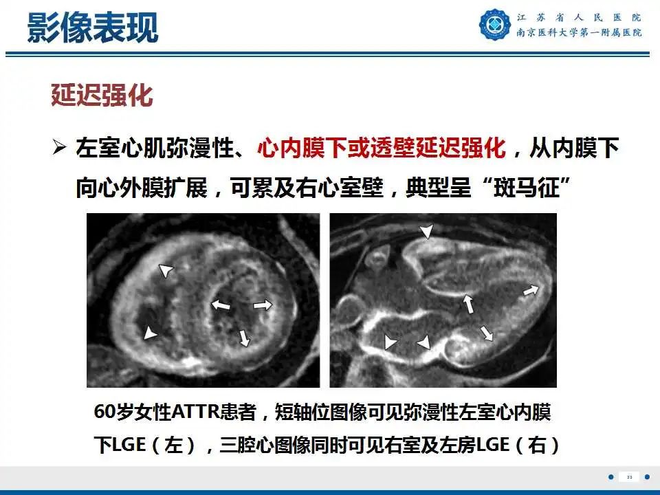 【PPT】心肌淀粉样变-34