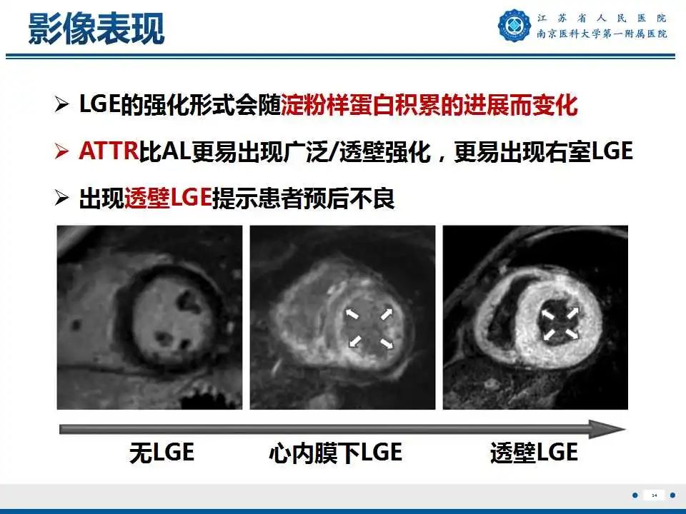 【PPT】心肌淀粉样变-35