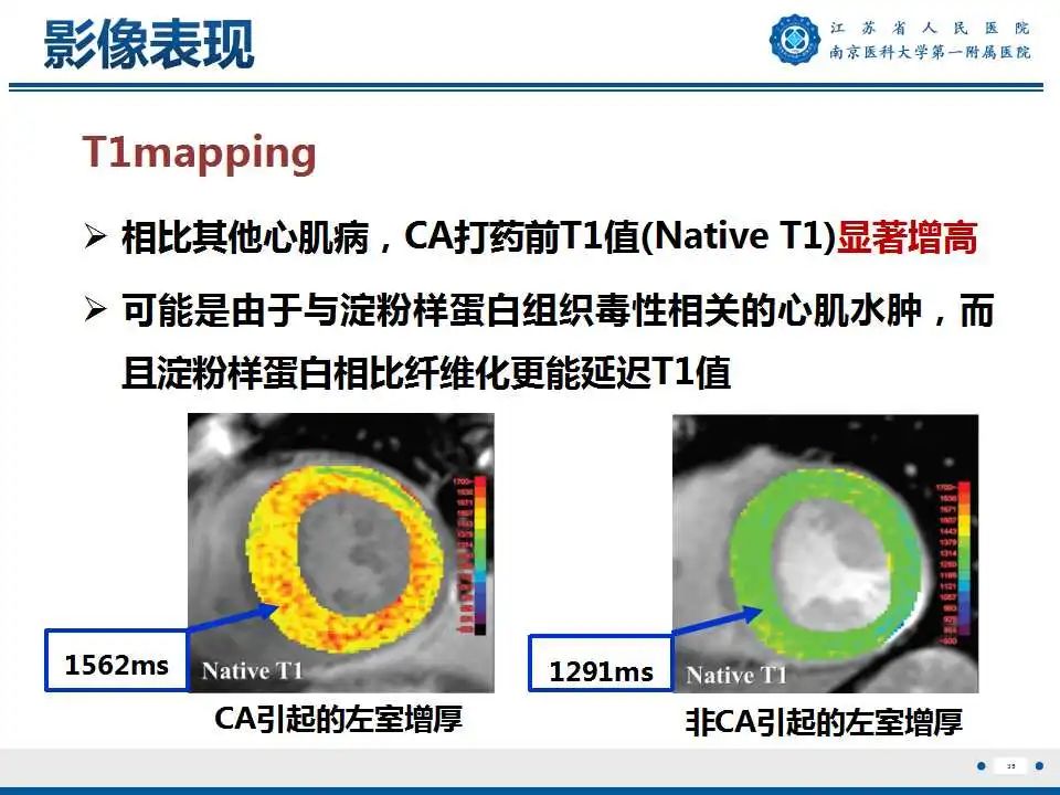 【PPT】心肌淀粉样变-36