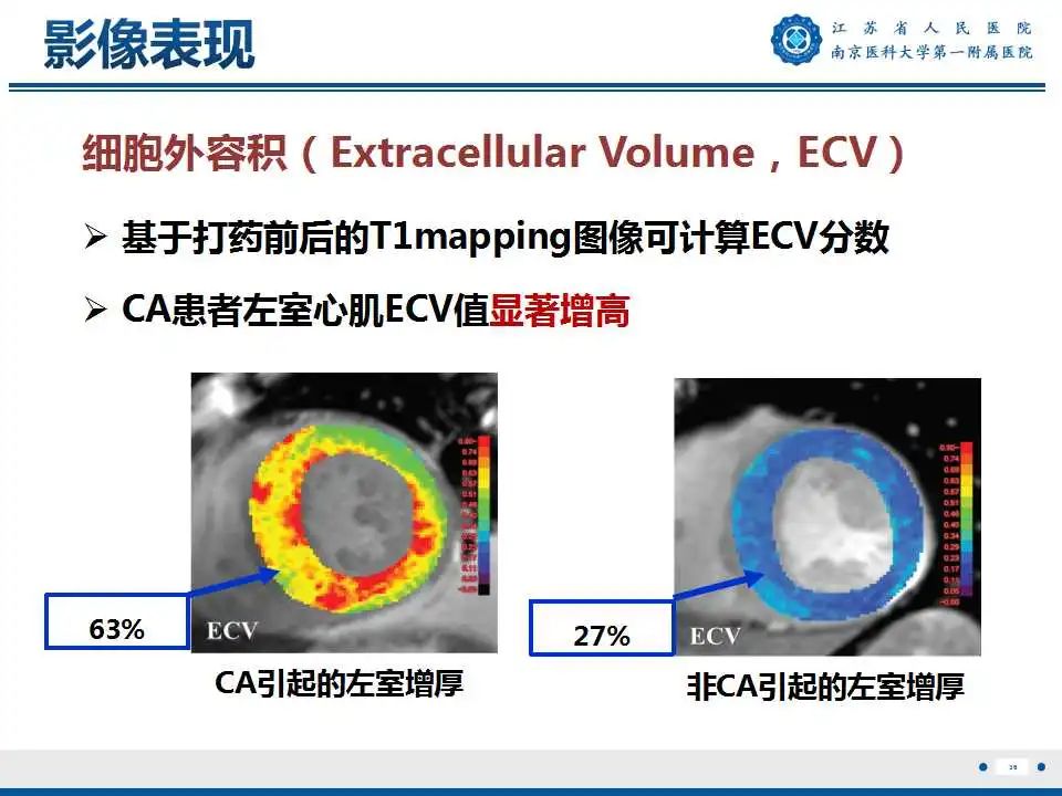 【PPT】心肌淀粉样变-37