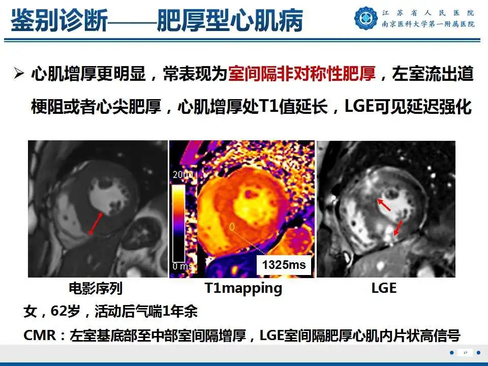 【PPT】心肌淀粉样变-38