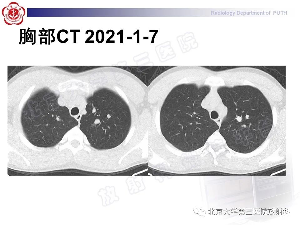 【PPT】变态反应性支气管肺曲霉菌病-3