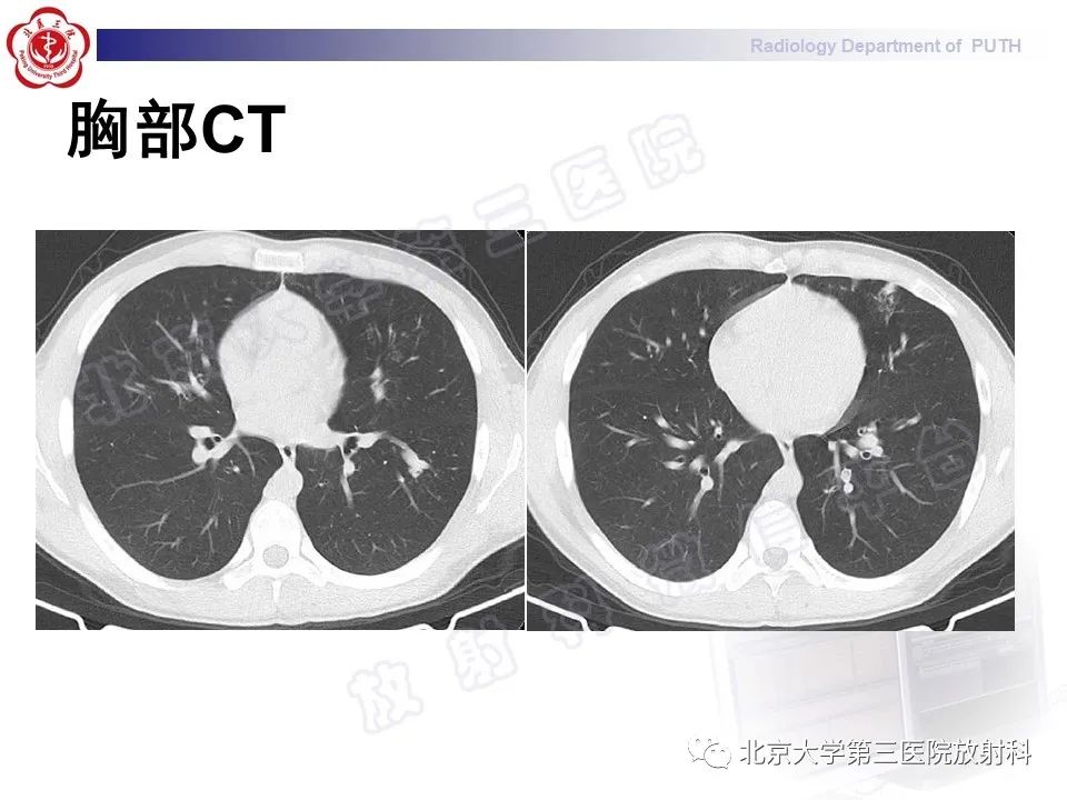 【PPT】变态反应性支气管肺曲霉菌病-4