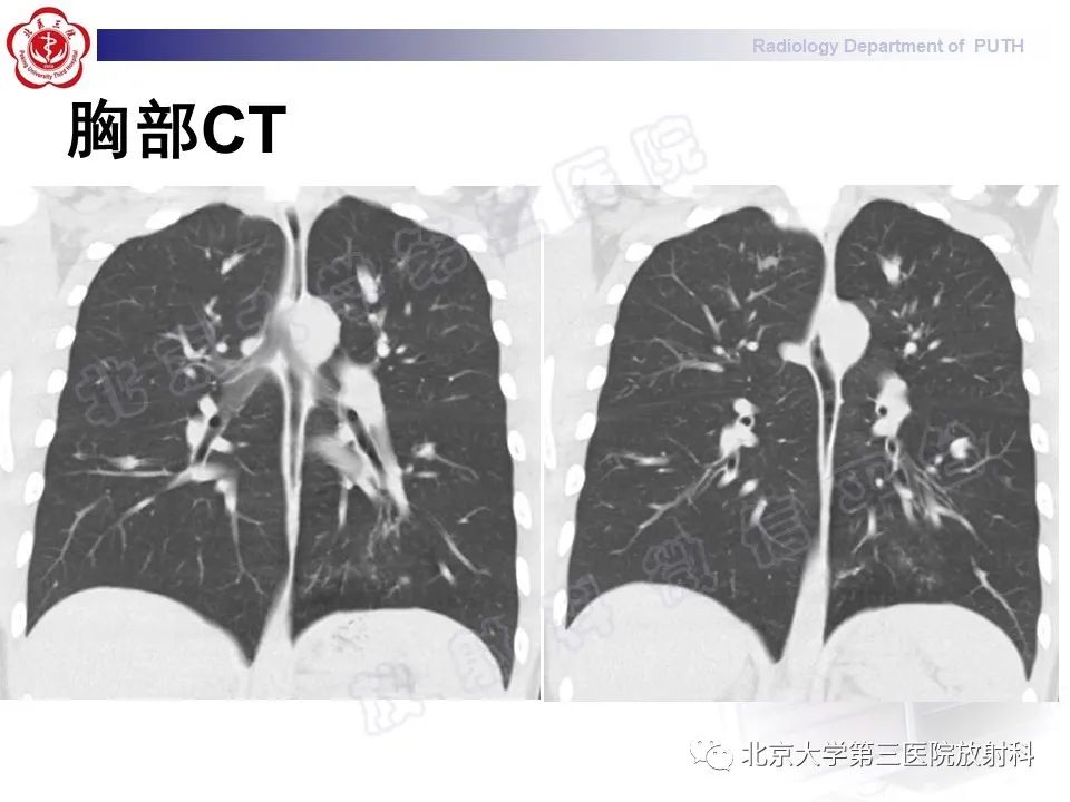 【PPT】变态反应性支气管肺曲霉菌病-5