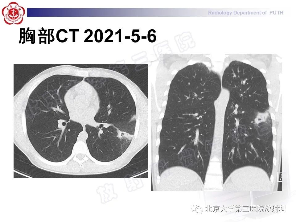 【PPT】变态反应性支气管肺曲霉菌病-8
