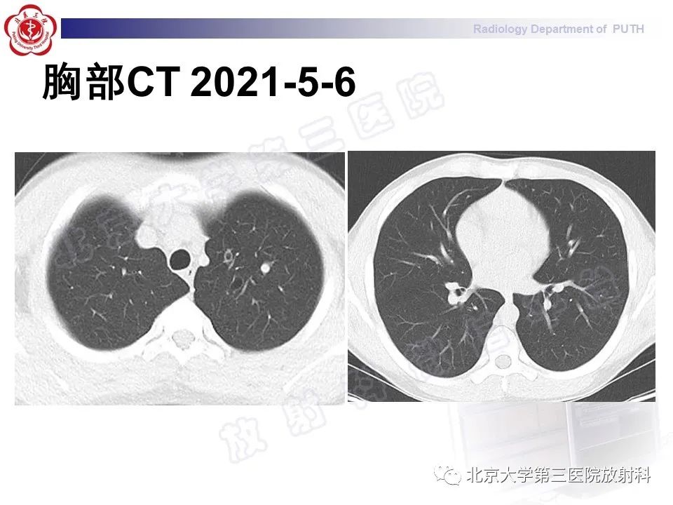 【PPT】变态反应性支气管肺曲霉菌病-11