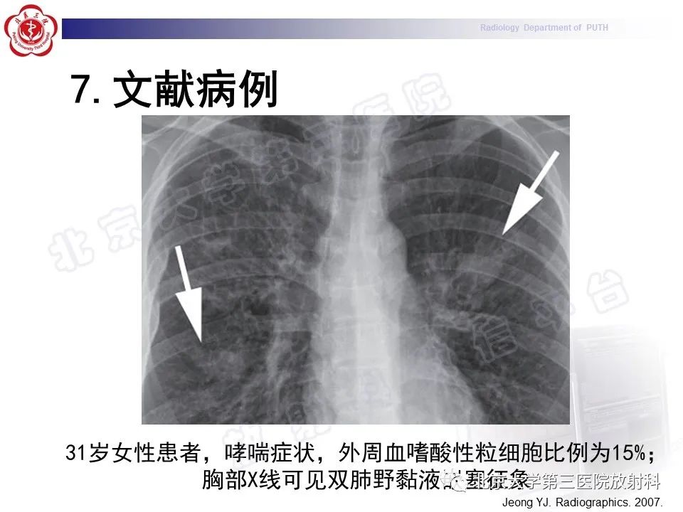 【PPT】变态反应性支气管肺曲霉菌病-27
