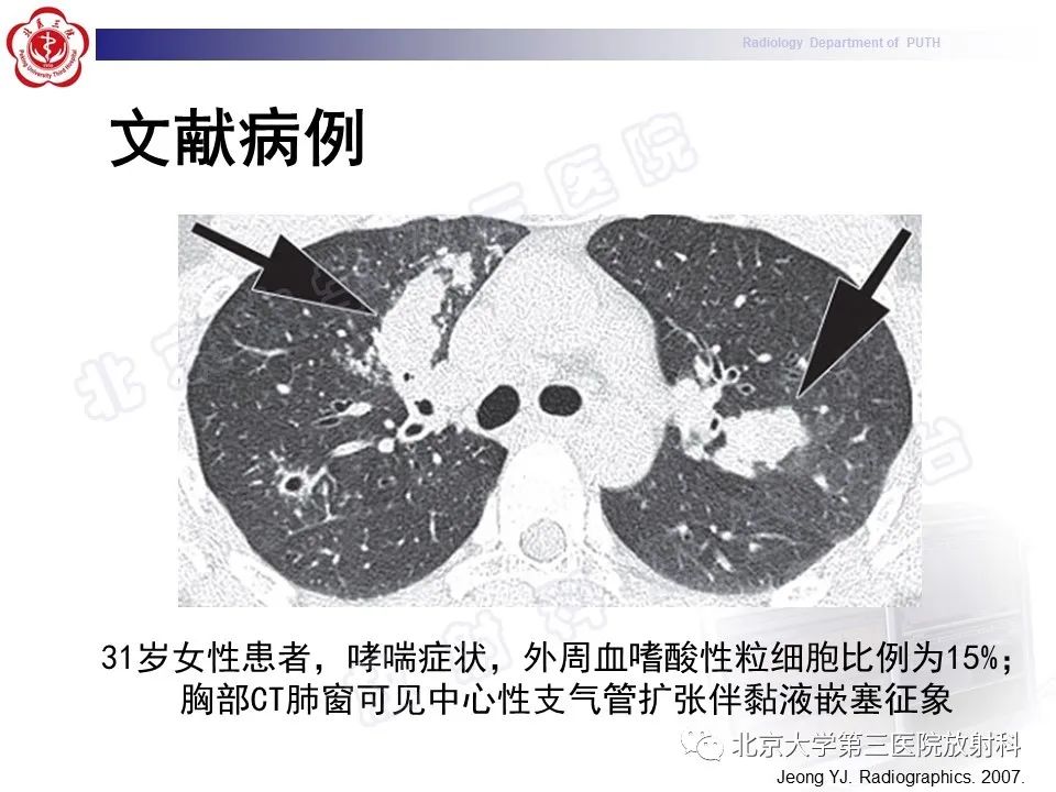【PPT】变态反应性支气管肺曲霉菌病-28