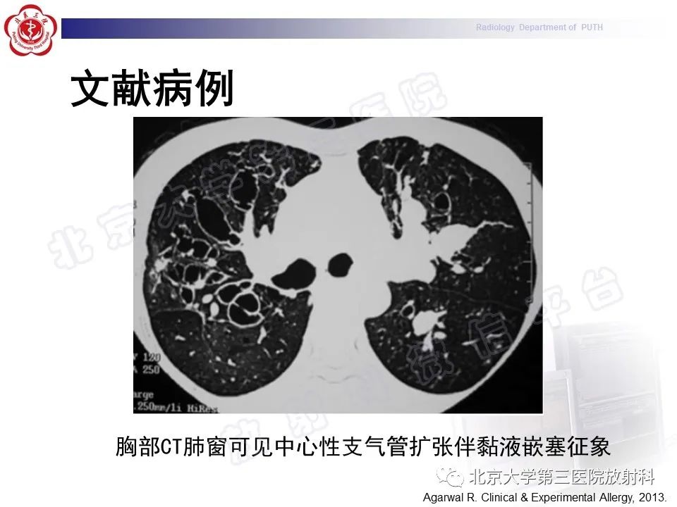 【PPT】变态反应性支气管肺曲霉菌病-29