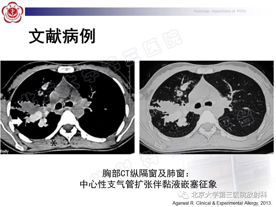 【PPT】变态反应性支气管肺曲霉菌病-30