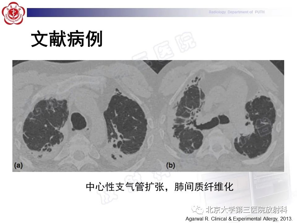 【PPT】变态反应性支气管肺曲霉菌病-31