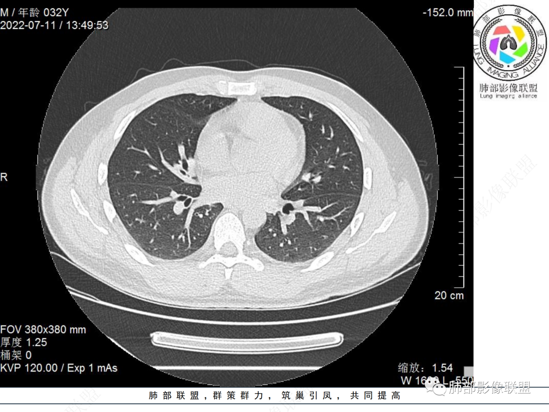 【病例】支气管腔内结节灶，你能想到哪些病变？-3