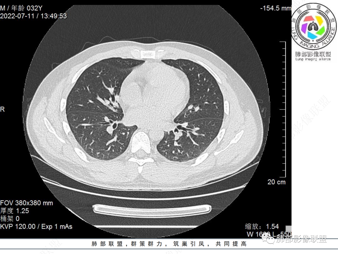 【病例】支气管腔内结节灶，你能想到哪些病变？-5