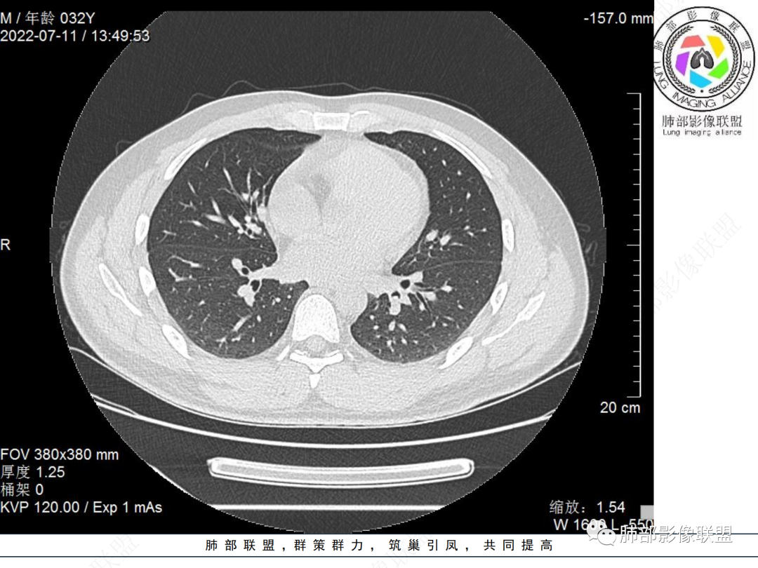 【病例】支气管腔内结节灶，你能想到哪些病变？-6