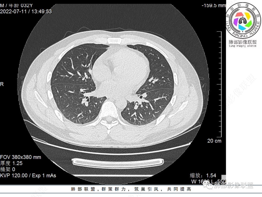 【病例】支气管腔内结节灶，你能想到哪些病变？-9