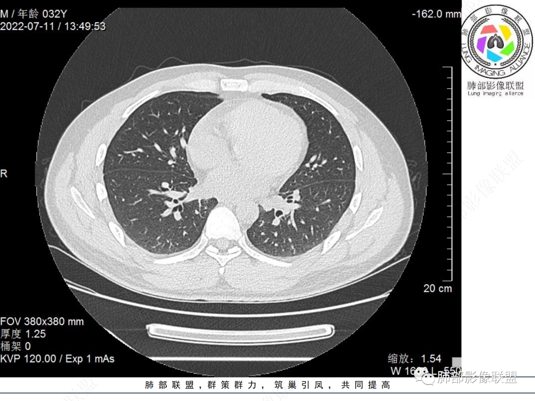 【病例】支气管腔内结节灶，你能想到哪些病变？-10