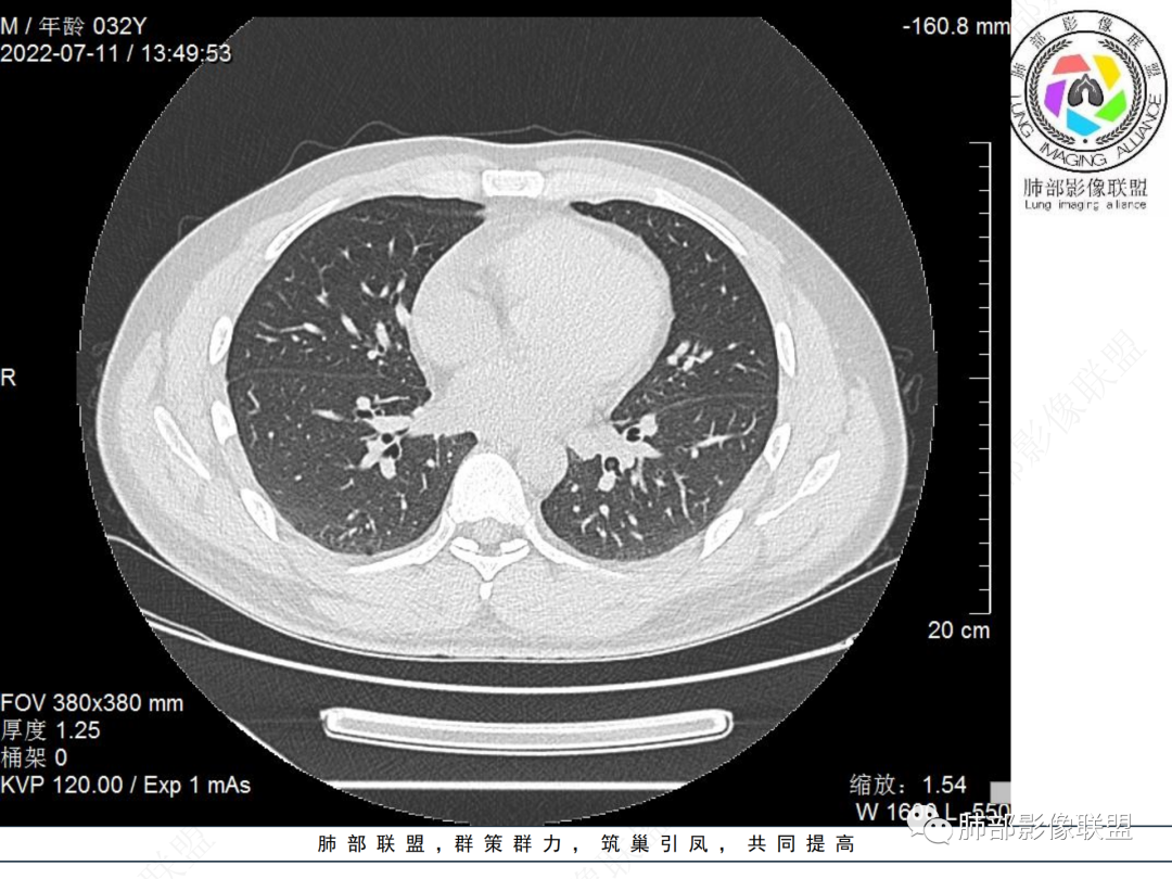 【病例】支气管腔内结节灶，你能想到哪些病变？-11