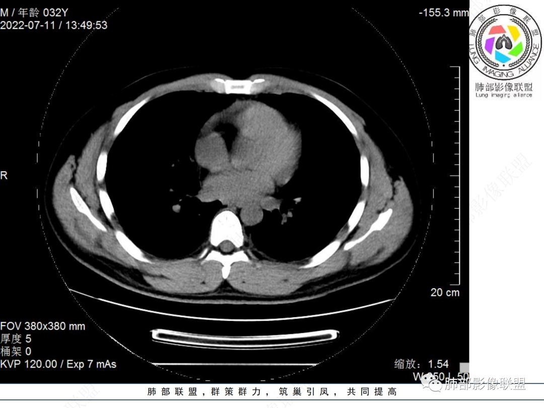 【病例】支气管腔内结节灶，你能想到哪些病变？-12