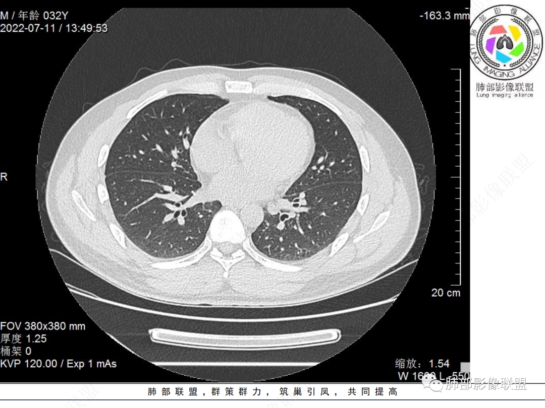 【病例】支气管腔内结节灶，你能想到哪些病变？-13