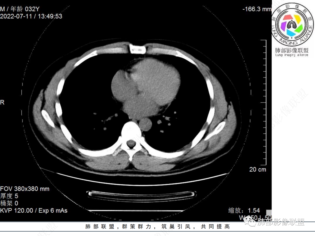 【病例】支气管腔内结节灶，你能想到哪些病变？-14