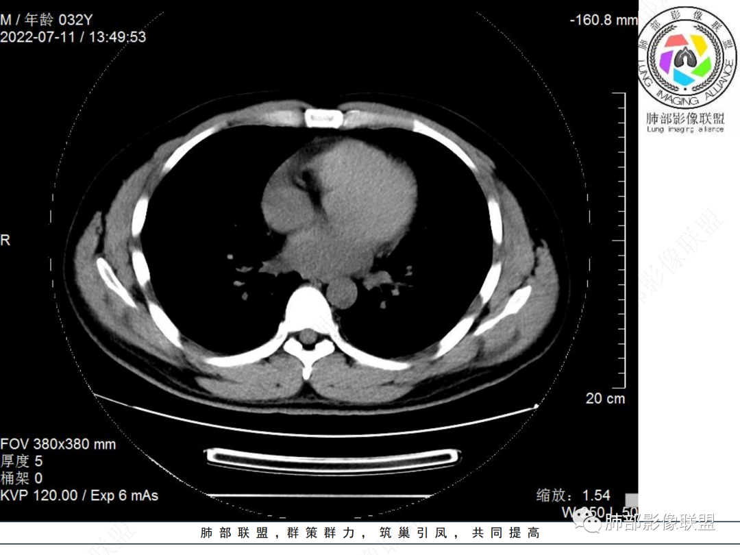 【病例】支气管腔内结节灶，你能想到哪些病变？-15