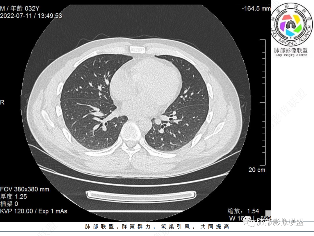 【病例】支气管腔内结节灶，你能想到哪些病变？-16