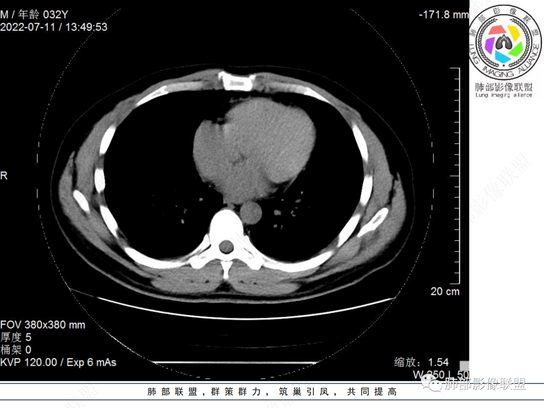 【病例】支气管腔内结节灶，你能想到哪些病变？-18